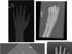 Đánh giá tuổi xương của trẻ em qua ảnh X-quang bằng AI